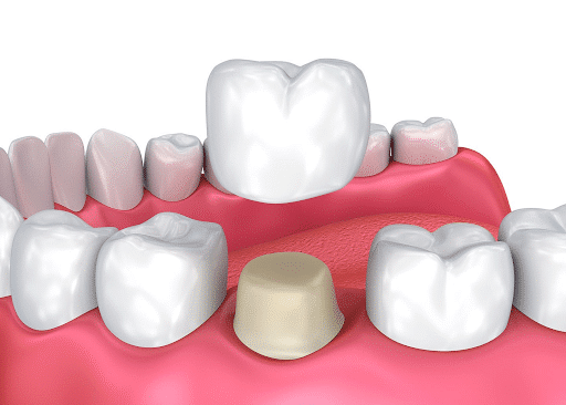 Ponciano Dental - Dental Crowns in Davisville Ponciano Dental - Dental Crowns in Davisville